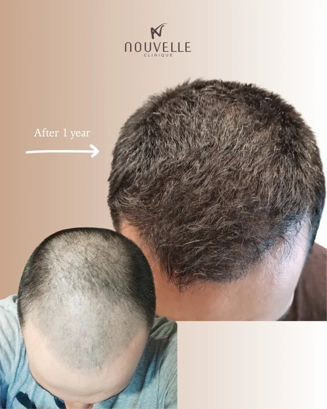 Before and after photo: crown 12 months after hair transplant — Nouvelle Clinique, Tirana