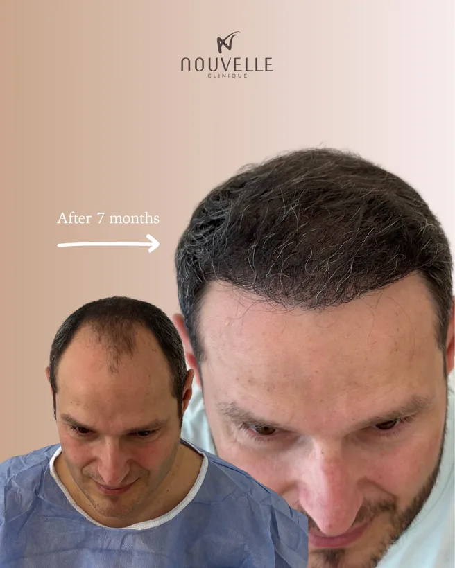 Foto prima e dopo: corona a 7 mesi dal trapianto di capelli — Nouvelle Clinique, Tirana