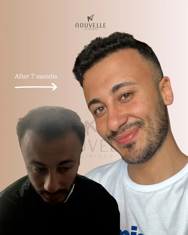 Before and after photo: frontal area 7 months after hair transplant — Nouvelle Clinique, Tirana