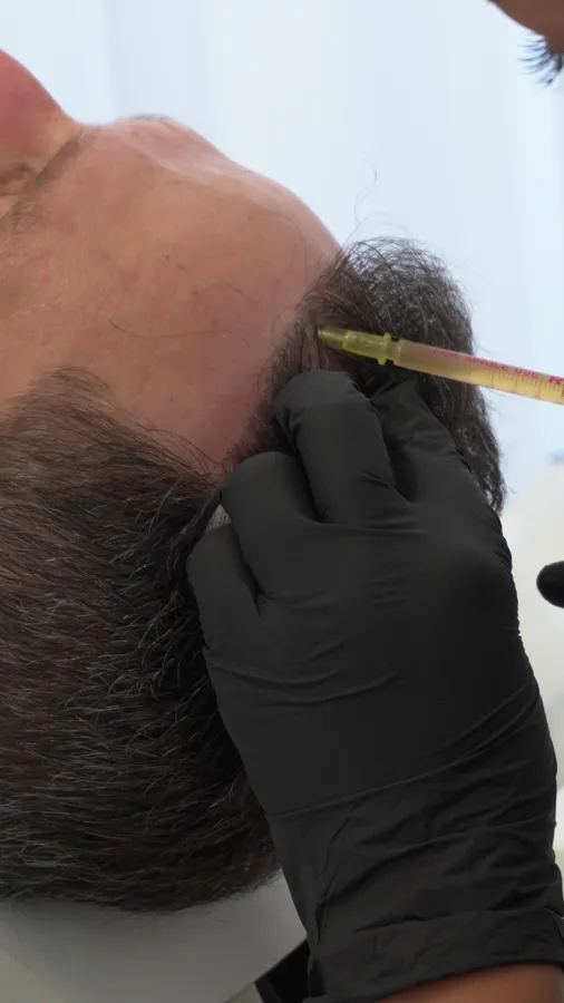 Impianto DHI sull'attaccatura in una clinica partner a Tirana: la mano guantata del chirurgo posiziona gli innesti con la penna implanter
